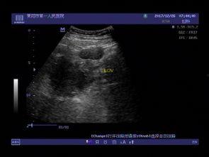 阑尾囊肿可以吃蜜瓜吗,阑尾囊肿患者蜜瓜食用指南